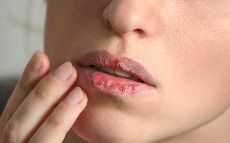 Tiểu đường có thể là nguyên nhân gây khô miệng
