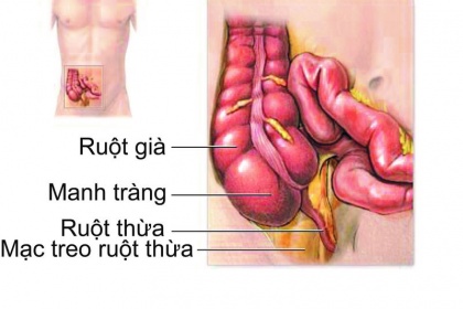 Các bệnh thường gặp ở ruột thừa - ảnh 1