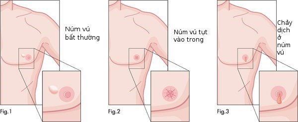 Những yếu tố nhận biết ung thư vú ở nam giới - ảnh 1
