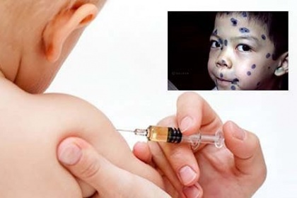 Vắc-xin thủy đậu - Những điều các mẹ cần biết - ảnh 1