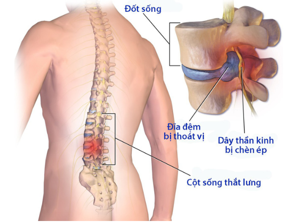 Thoát vị đĩa đệm lưng và Các phương pháp điều trị - ảnh 1