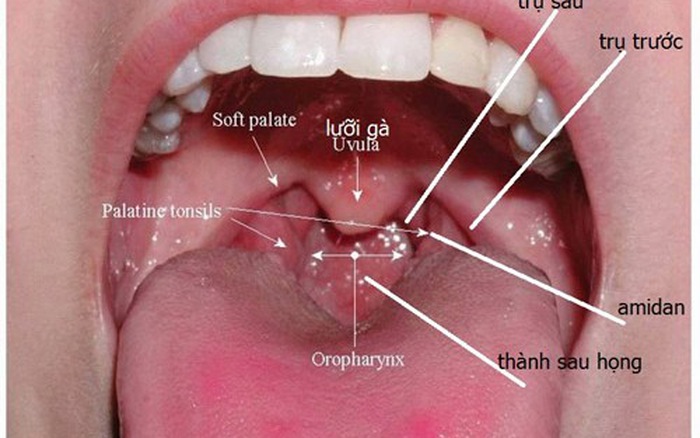 Những hình ảnh về bệnh ung thư vòm họng - ảnh 1