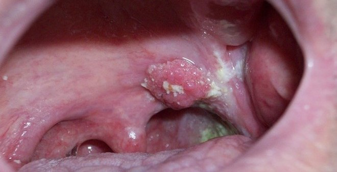 Những hình ảnh về bệnh ung thư vòm họng - ảnh 4