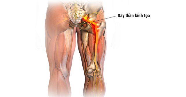 6 Bác sĩ chữa đau thần kinh tọa hàng đầu và đáng tin cậy tại Hà Nội - ảnh 1
