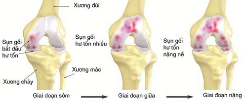10 Địa điểm đáng tin cậy để khám và điều trị thoái hóa khớp gối tại Hà Nội - ảnh 1