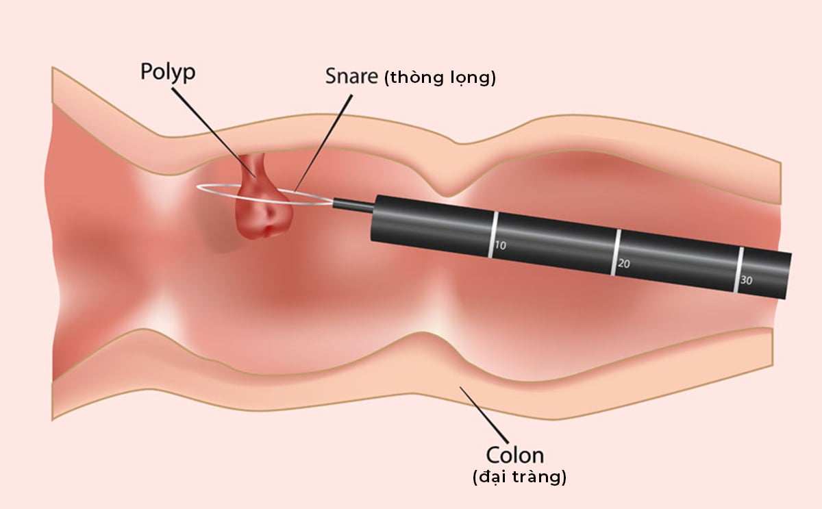 Nội soi cắt polyp ở đâu tốt tại Hà Nội: Đánh giá 7 bệnh viện hàng đầu - ảnh 1