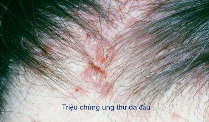 5 dấu hiệu ung thư da đầu dễ nhận biết - ảnh 1