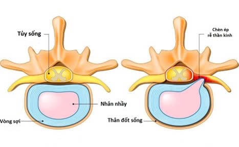 Điều trị thoát vị đĩa đệm bằng phương pháp Chiropractic - ảnh 1