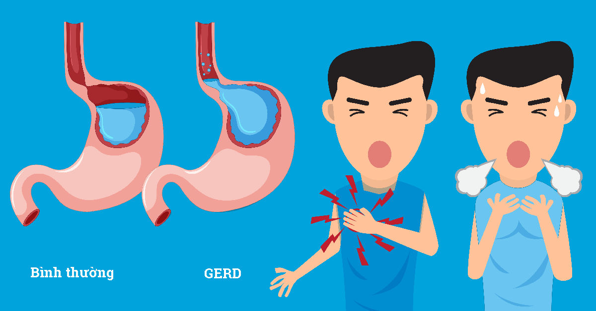 6 vấn đề quan trọng cần biết về Trào ngược dạ dày thực quản - ảnh 1