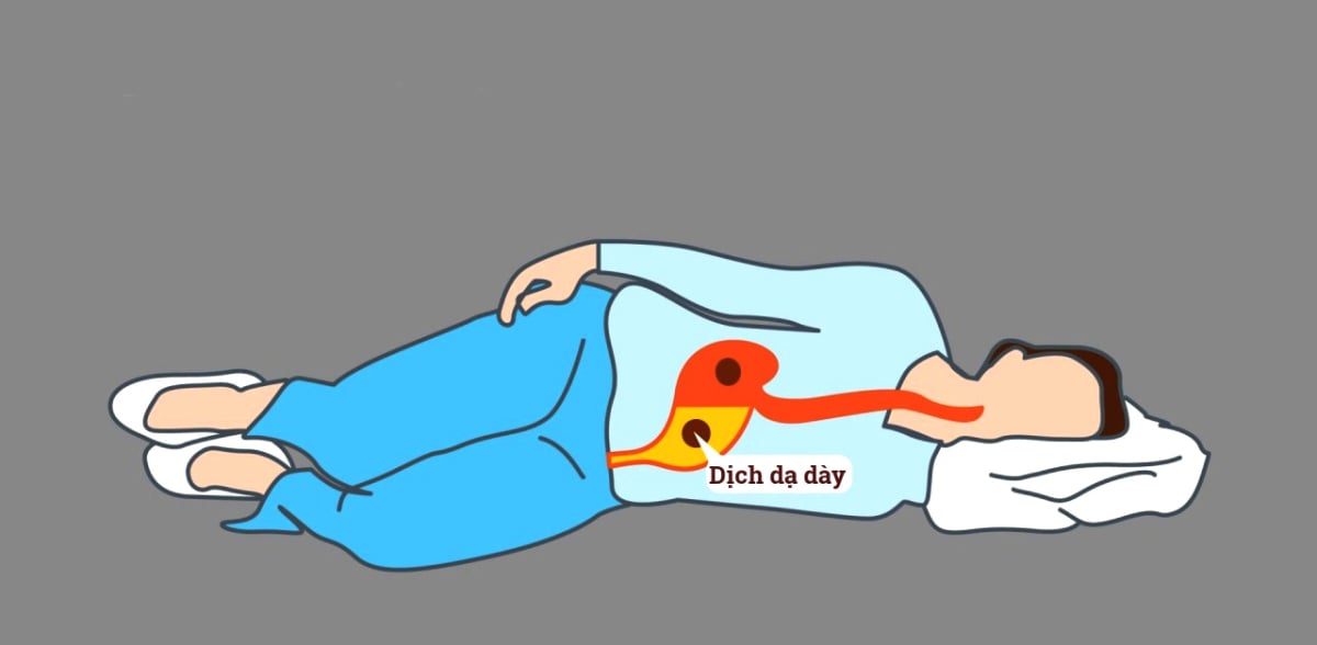 6 vấn đề quan trọng cần biết về Trào ngược dạ dày thực quản - ảnh 2