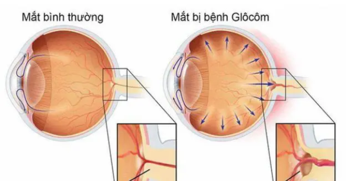 8 cơ sở khám và điều trị Glocom (Thiên đầu thống) uy tín tại Hà Nội - ảnh 1