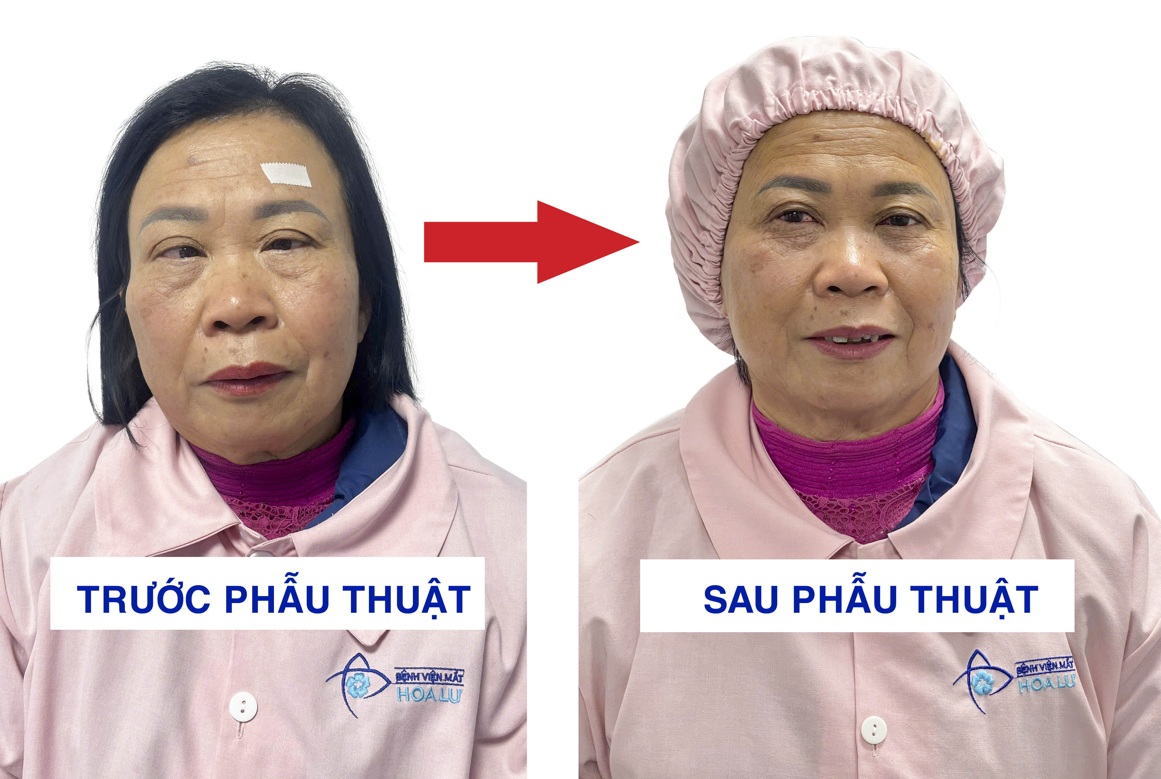 60 năm sống với đôi mắt lác: “Tôi ước gì mình dám thay đổi sớm hơn…” - ảnh 1