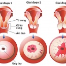 Tầm soát ung thư cổ tử cung, tử cung