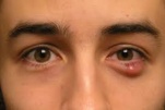 Phương pháp điều trị Mộng thịt ở mắt