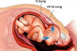 Phẫu thuật bảo tồn tử cung do vỡ tử cung