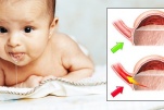 Trào ngược dạ dày thực quản ở trẻ sơ sinh