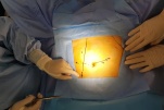 Lợi ích của phẫu thuật Robot so với phẫu thuật mổ hở và nội soi