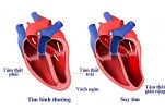 Suy tim - Nguyên nhân và Phương pháp điều trị hiệu quả