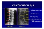 Chụp X quang cột sống cổ chếch 3⁄4 để chẩn đoán bênh cột sống