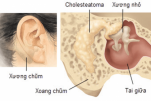Viêm tai xương chũm cấp tính ở trẻ em - Triệu chứng - Điều trị và phòng bệnh