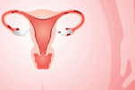 Lạc nội mạc tử cung và thụ tinh trong ống nghiệm IVF điều trị vô sinh