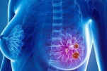 Giảm nguy cơ ung thư vú cho phụ nữ có nguy cơ cao