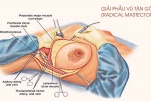 Tìm hiểu về phẫu thuật cắt bỏ vú điều trị nang tuyến vú