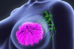 Ung thư vú tái phát có những triệu chứng gì?