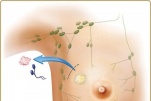 Điều trị bảo tồn tuyến vú cho bệnh nhân ung thư vú