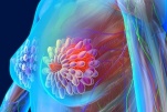 Yếu tố giúp thay đổi nguy cơ mắc ung thư vú ở phụ nữ
