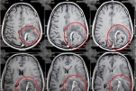 Quy trình chụp cộng hưởng từ sọ não có tiêm thuốc đối quang từ
