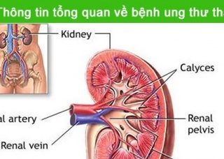 Ảnh 1 của Kidney cancer