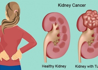 Ảnh 2 của Kidney cancer