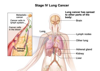 Ảnh 3 của Kidney cancer