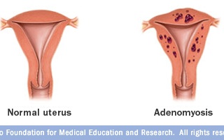 Ảnh 3 của Adenomyosis