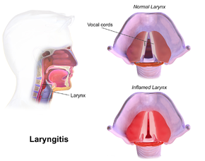 Ảnh 2 của Laryngitis