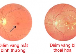 Ảnh 4 của Age-related Macular Degeneration