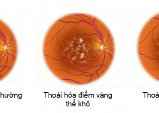 Ảnh 2 của Age-related Macular Degeneration