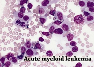 Ảnh 2 của Acute myeloid leukemia (ALL)
