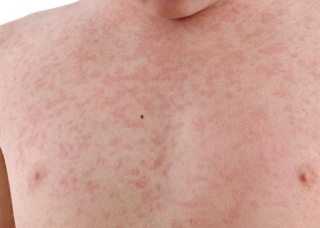 Ảnh 1 của Measles