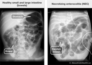 Ảnh 2 của Necrotizing Enterocolitis