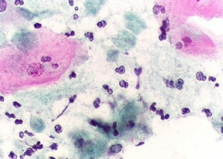 Ảnh 4 của Nhiễm nấm Candida