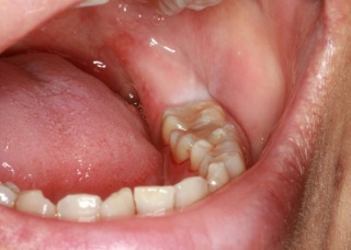Ảnh 4 của Nhiễm trùng răng