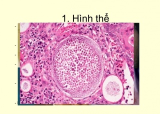 Ảnh 3 của Nhiễm trùng mũi do nấm Rhinosporidiosis