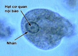 Ảnh 2 của Nhiễm khuẩn Entamoeba Histolytica