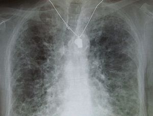 Ảnh 4 của Pulmonary fibrosis
