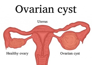 Ảnh 4 của Ovarian Cysts