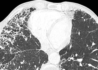 Ảnh 2 của Pulmonary fibrosis