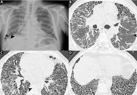Ảnh 3 của Pulmonary fibrosis