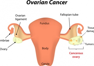 Ảnh 2 của Ovarian cancer
